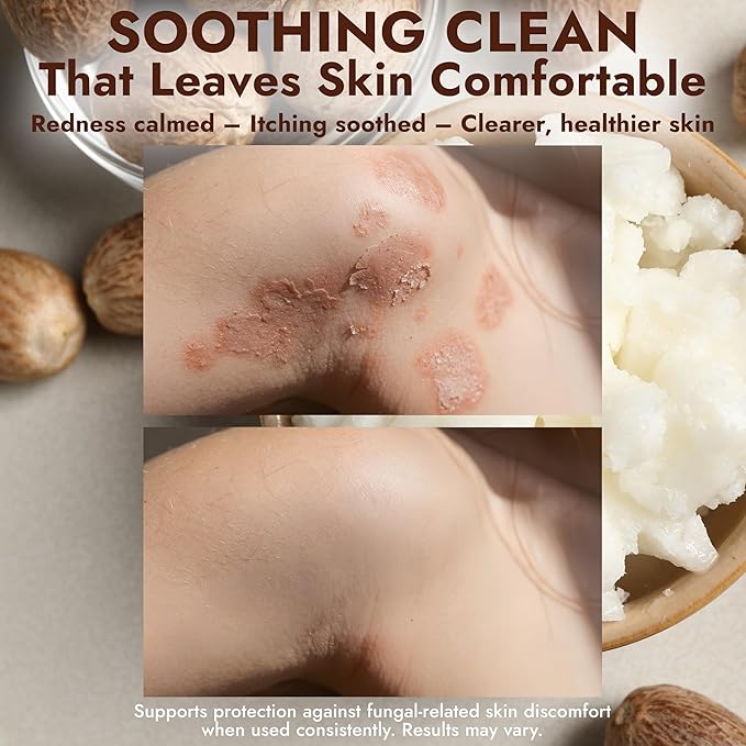 Antifungal Soap Infused with Shea Butter & Rose Oil | Medicated Jock Itch Treatment Helps Fight Ringworm & Athlete’s Foot | Tolnaftate 1% Antifungal Soap for Deep Cleansing | 2 Bars with Scrubber