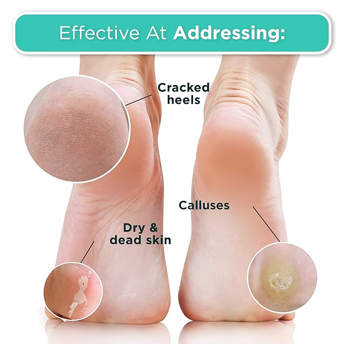 DERMORA Foot Peel Mask | Skin Exfoliating Foot Masks for Dry, Cracked Feet & Callus Removal | Dead Skin Exfoliator for Baby Soft Feet | Pack of 4 | Regular (Fits up to Men 10 / Women 11) | Original