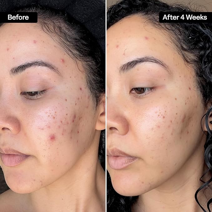 QRxLabs Glycolic Acid Pads - 20% Resurfacing Pads AHA for Face & Body - Exfoliates Skin Surface and Reduces Appearance of Fine Lines and Wrinkles - Acne Treatment Clearing - Daily Pads - 50ct