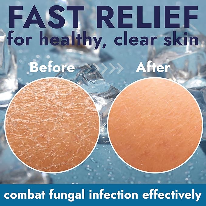 Antifungal Soap Infused with Peppermint Essential Oil | Medicated Tolnaftate 1% Soap for Itchy Skin, Athlete’s Foot, Ringworm & Jock Itch Treatment | Spearmint Freshness Bars Pack of 2 with Scrubber