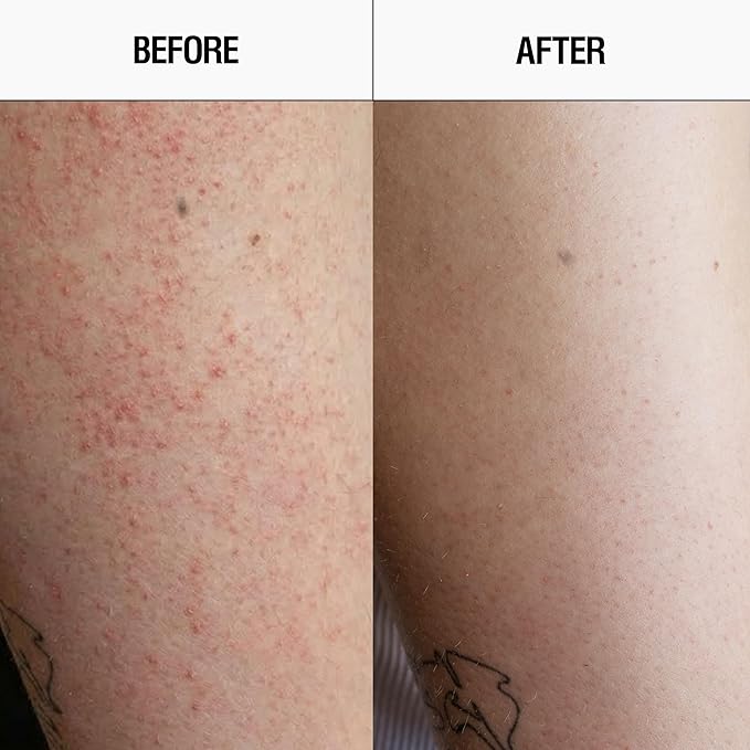 Grown Alchemist Resurfacing Targeted Body Cleanser – Smoother Skin from the First Use – Acne Body Wash & Exfoliator for Keratosis Pilaris with Salicylic, Lactic & Glycolic Acids, 300mL