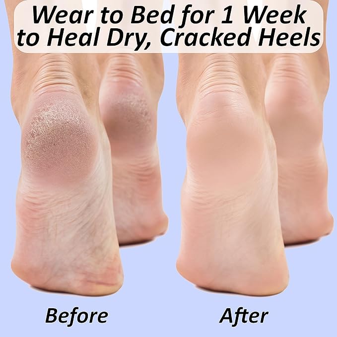 Moisturizing Socks for Cracked Heel Treatment: Socks for Cracked Heel Repair, Silicone Toeless Socks, Spa Gel Socks for Dry Cracked Feet Women, Lotion Moisture Pedicure Socks