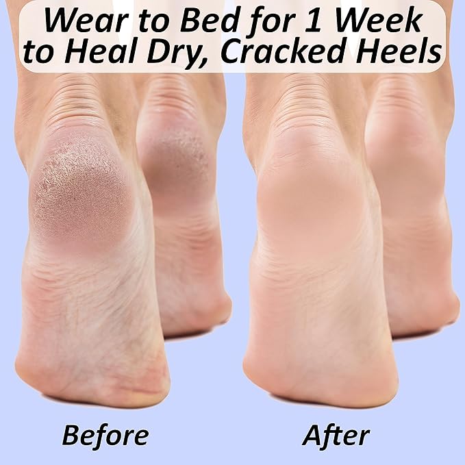 6 Pairs, Moisturizing Socks for Cracked Heel Treatment: Socks for Cracked Heel Repair, Silicone Toeless Socks, Spa Gel Socks for Dry Cracked Feet Women, Lotion Moisture Pedicure Socks
