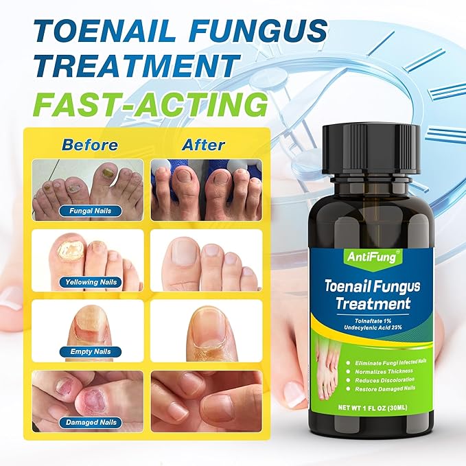 Toenail Fungus Treatment Extra Strength – Maximum OTC with 25% Undecylenic Acid – for Thick, Nail Strengthener and Growth, for Broken, Discolored Nail & Ingrown Toenail, 30ml