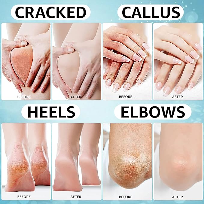 42% Urea Cream PLUS with 2% Salicylic Acid | High Strength Formula for Cracked Heels, Thick Calluses & Dry Rough Skin | Quick Absorbing Low Crystallization Hydrating Foot Moisturizer – 4 Oz