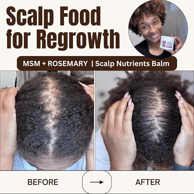 Qhemet Biologics MSM + Rosemary Scalp Nutrients Balm | Food for Hair Growth | MSM, Rosemary, Bhringraj, Castor Oil & Coconut Oil | For Dry Scalp, Thinning & Slow Growth | Vegan (4 oz)