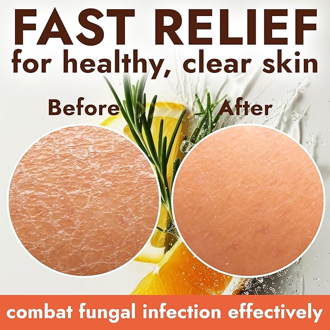 Antifungal Soap with Lemon Oil | Medicated Jock Itch Treatment Helps Fight Ringworm & Athlete’s Foot | Tolnaftate 1% Antifungal Cleansing Bars with Case | Infused with Sweet Orange & Grapefruit Oils