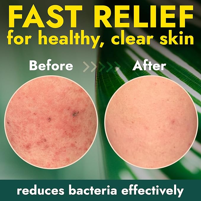 Antibacterial Body Wash with Tea Tree Oil | Antibacterial Soap for Men & Women | Kills 99.9% of Germs & Bacteria | Helps with Back Acne, Body Odor & Skin Irritation | Daily Body Cleanser 16 fl oz