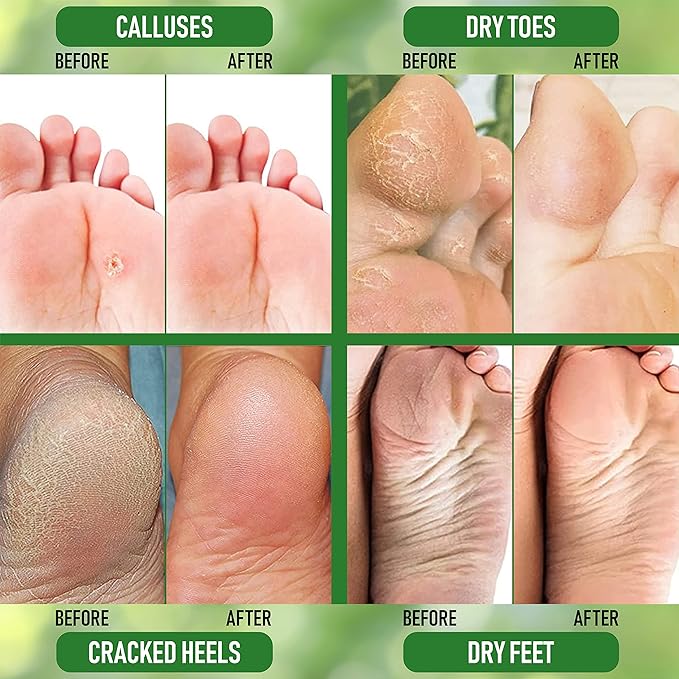 PurOrganica Urea Cream 20% – Made in USA, Maximum Strength Foot Cream for Dry, Cracked Heels, Corns, Calluses & Rough Feet, Exfoliating Moisturizer