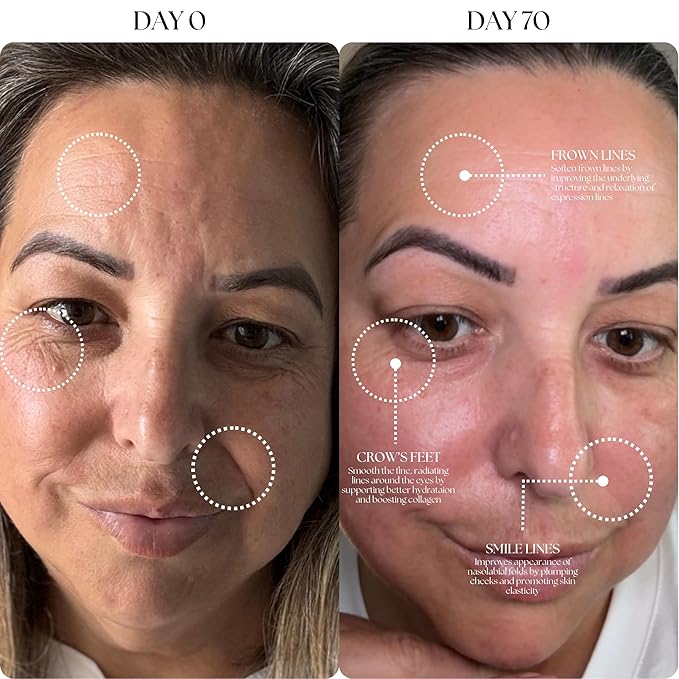 Mon Lumiere Micro Infusion System for Face – Gold Spring-Loaded Facial Stamp with PDRN & Peptides – At-Home Skincare Kit for Glow, Smoother-Looking Skin & Visible Radiance – 3 Single-Dose Serums