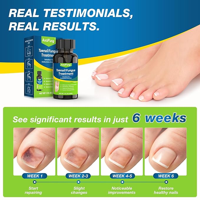 Toenail Fungus Treatment Extra Strength – Maximum OTC with 25% Undecylenic Acid – for Thick, Nail Strengthener and Growth, for Broken, Discolored Nail & Ingrown Toenail, 30ml