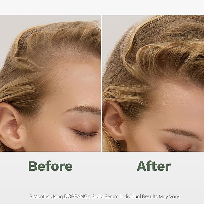 Scalp Serum for Thinning Hair, Clinically Tested Vegan Formula with Capixyl and AnaGain, Promotes Fuller-Looking Hair & Healthy Scalp, Peptide Non-Greasy for Dry Sensitive Scalps 60ml