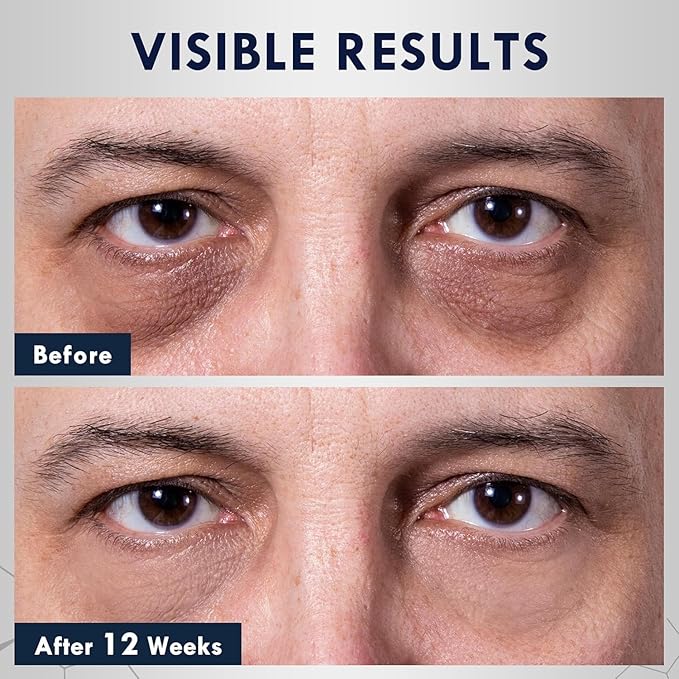 Eye Bags Treatment for Men, Caffeine Eye Serum for Men with Cooling Roller, Mens Eye Cream for Dark Circles and Puffiness (0.5 Fl Oz (Pack of 1))