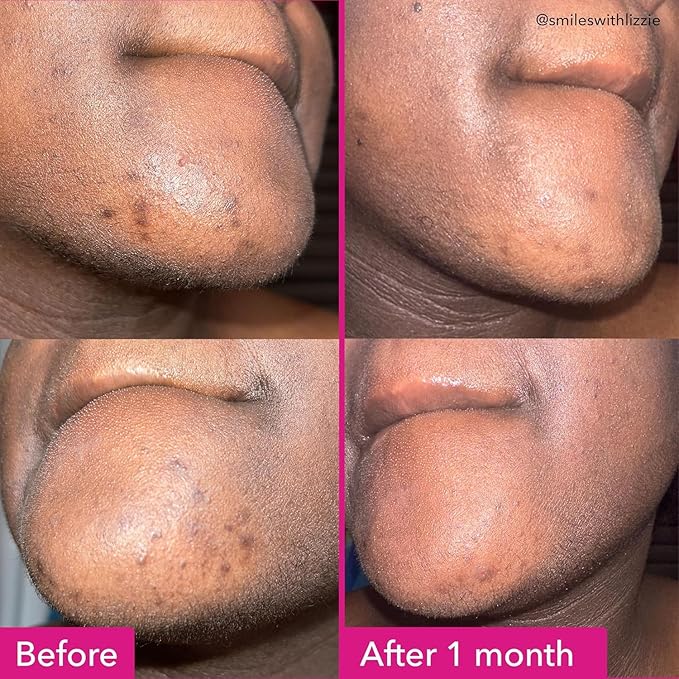Good Molecules Brightening & Dark Spots Bar - Soap Free Face and Body Bar - Tranexamic, Kojic Acids and Niacinamide to Target Dark Spots - Skin Care