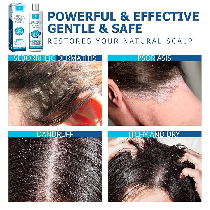 Roycederm Seborrheic Dermatitis & Psoriasis Shampoo for Dandruff - Helps Relieve Itching, Flaking & Scaling, Dry Itchy Scalp