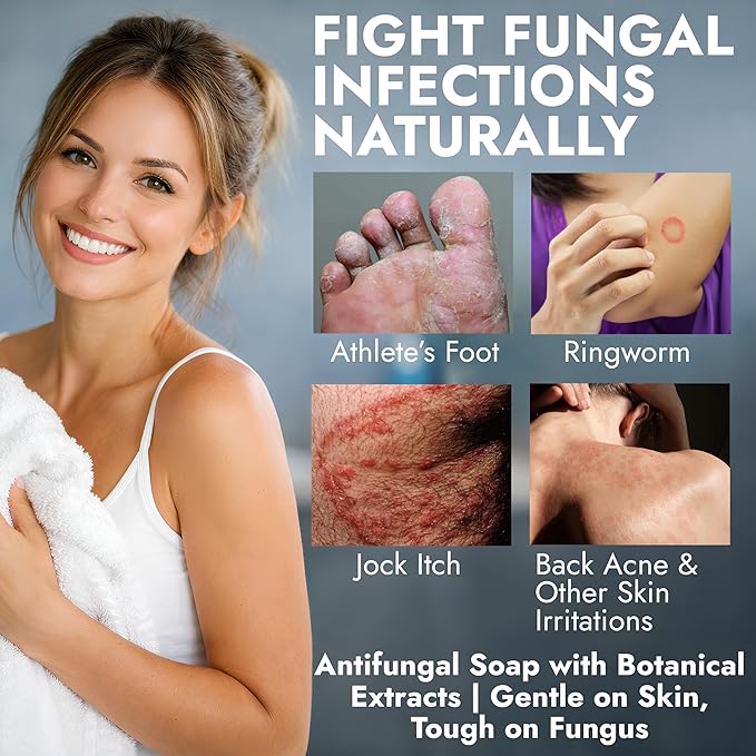 Antifungal Soap Infused with Shea Butter & Rose Oil | Medicated Jock Itch Treatment Helps Fight Ringworm & Athlete’s Foot | Tolnaftate 1% Antifungal Soap for Deep Cleansing | Pack of 2 Bars with Case