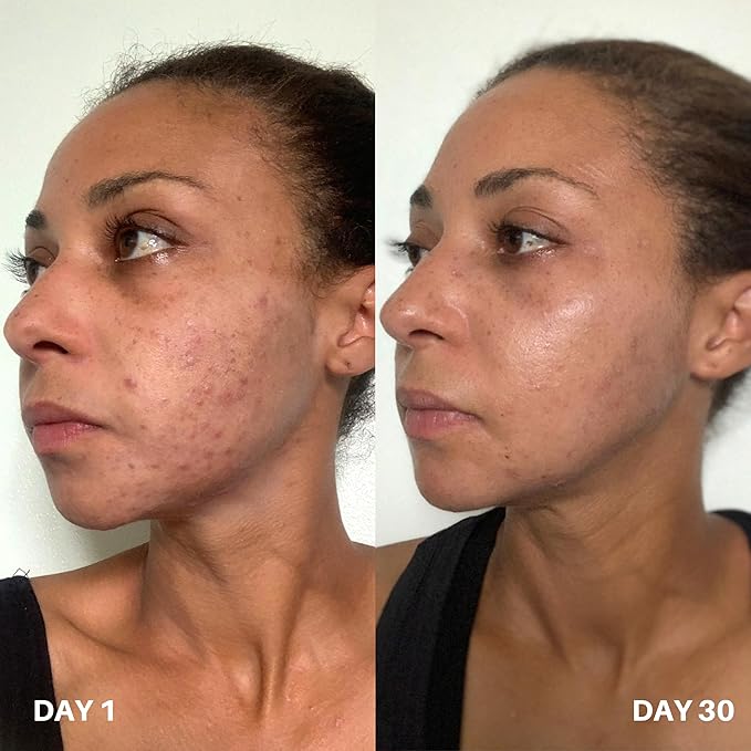 Clinisoothe+ Skin Purifier – Daily Cleanser and Acne Treatment for Face & Body, with Hypochlorous Technology to Prevent Breakouts & Promote Rapid Recovery, For All Skin Types (8.4oz Pour Bottle)