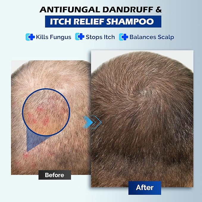 Antifungal Psoriasis Shampoo for Seborrheic Dermatitis, Folliculitis & Scalp Psoriasis, Anti-Dandruff Shampoo for Men & Women, Relieves Scalp Itching, Dryness, Sulfate & Paraben-Free, 10.1 Fl Oz-Fresh