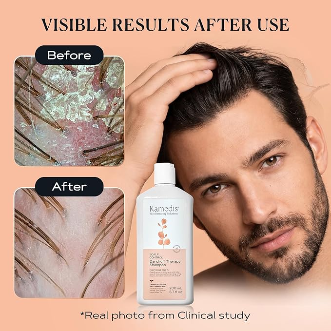 KAMEDIS Scalp Savior – Itchy Dry Scalp Treatment & Seborrheic Dermatitis Relief. Anti Dandruff Shampoo Clinically Formulated With Zinc Pyrithione & Salicylic Acid. Gentle SLS Free Formula. 6.7 Fl Oz