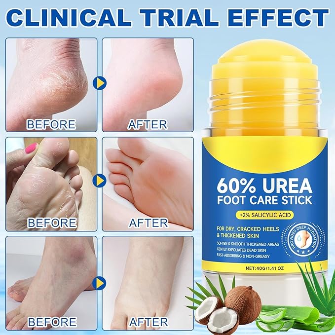 2 Pack Urea Cream 60% plus Salicylic Acid 2%, Maximum Strength Urea Foot Cream, Moisturizing Foot Balm Stick, Callus Remover & Dead Skin Exfoliator for Dry Cracked Feet, Heels, Hands, Knees Elbow
