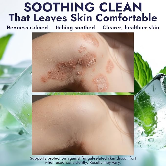 Antifungal Soap Infused with Peppermint Essential Oil | Medicated Tolnaftate 1% Soap for Itchy Skin, Athlete’s Foot, Ringworm & Jock Itch Care | Spearmint Freshness Cleansing Soap With Case Pack of 2