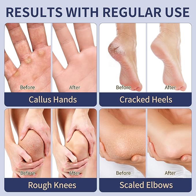 Veakoo Urea Cream 40 Percent for Feet Maximum Strength, Foot Cream with 2% Salicylic Acid, Dead Skin Cuticle Callus Remover, Urea Lotion for Intensive Repair of Dry Cracked Heels Hands