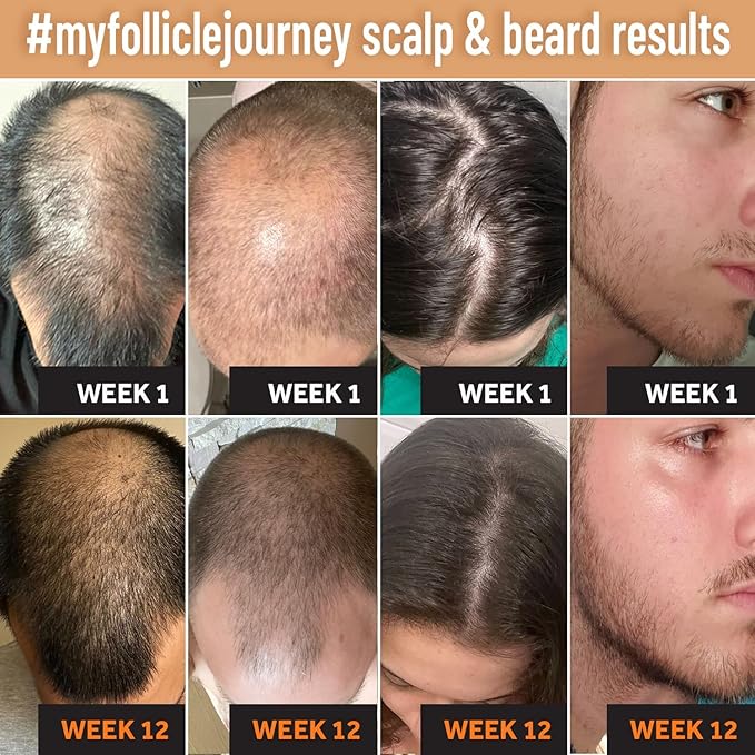 Biotin Hair Growth Shampoo for Men and Women - Thickening Treatment for Thinning Hair - Natural and Vegan DHT Blocker for Hair Loss - Caffeine, Saw Palmetto, Niacin, Argan Oil
