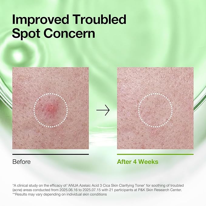 Anua Azelaic Acid 3 CICA Clarifying Toner, Soothing & Clear Care, with Salicylic & Azelaic Acid, Sebum & Spot Care, Suitable for Sensitive Skin, Korean Skincare, 8.45 fl.oz