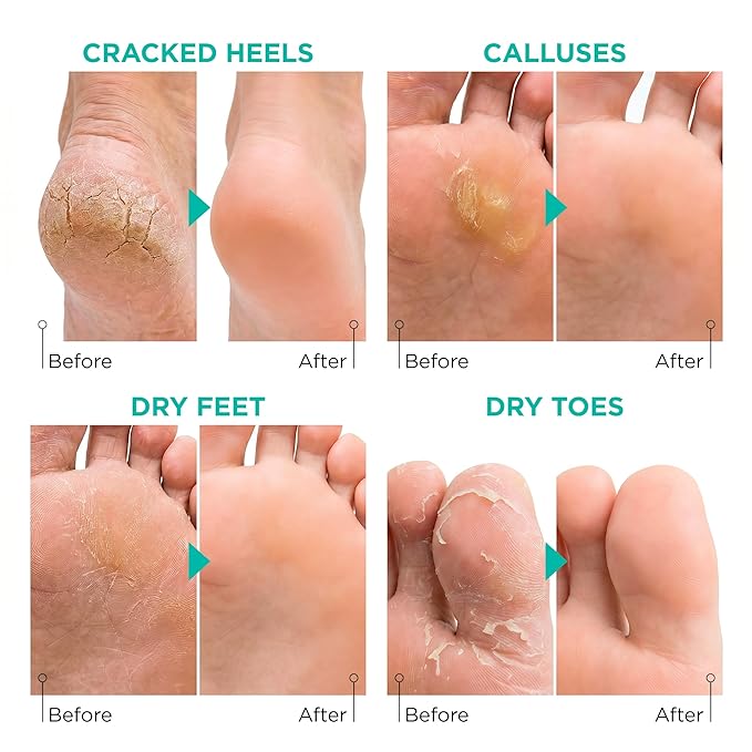 Foot Peel Mask for Dry Cracked Feet – 2 Pack Peeling Mask Removes Dead Skin and Calluses - Exfoliating for Soft Baby Feet, Original Scent