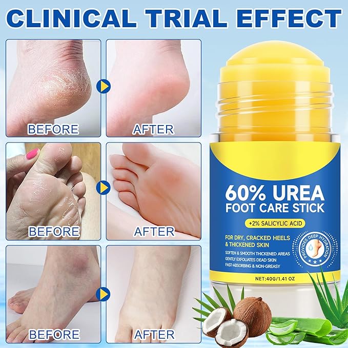 60% Urea Cream Stick plus 2% Salicylic Acid，Urea foot care stick，Suitable for dry and cracked feet, knees, Exfoliating Moisturizing Cream, Dead Skin Removal Foot Care Cream 1.4 oz (1-pack)