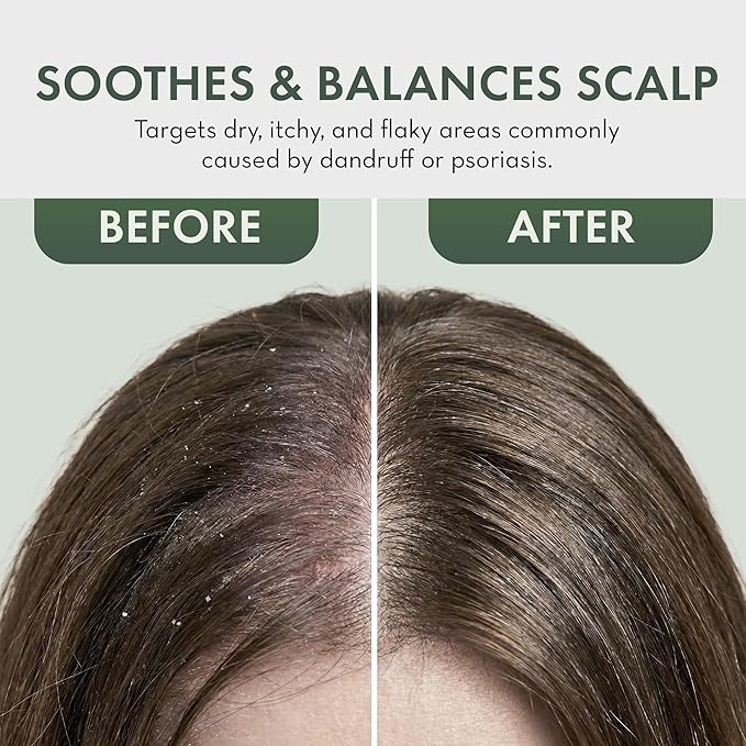 Leave In Conditioner Spray – Tea Tree Scalp Treatment (2 Pack) – Anti-Dandruff, Dry & Itchy Scalp Relief, Hydrating Formula for Psoriasis Care – Detangles & Nourishes Hair