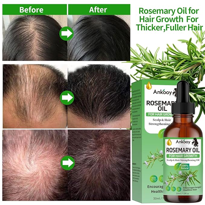 3 Pack Rosemary Oil for Hair Growth,Rosemary Hair Growth Oil,Strengthening Oil for Dry Damaged Hair,Hair Loss Treatment & Thickens Hair,Scalp Care Promotes Hair Thickness for Men Women