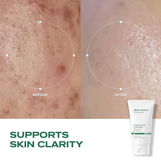 Cleansing Foam, Tea Tree Pore Deep Facial Cleanser for Oily & Sensitive Skin, Centella Asiatica, Green Tea, Korean Skincare, 5.07 fl oz (150 ml)