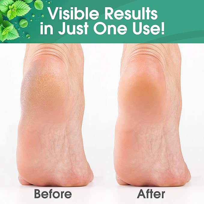 DeEnti Callus Remover for Feet, Extra Strength Foot Callus Remover Gel, 8oz Salon Grade Home Pedicure Supplies for Dry Skin, Cracked Heel, Professional Strength Foot Care, Cool Mint