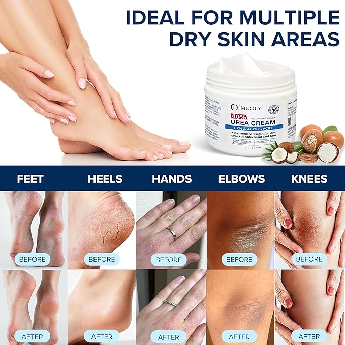 MEOLY 40% Urea Cream for Foot: Urea cream maximum strength with 2% Salicylic Acid for dry cracked skin hand and foot 2 oz