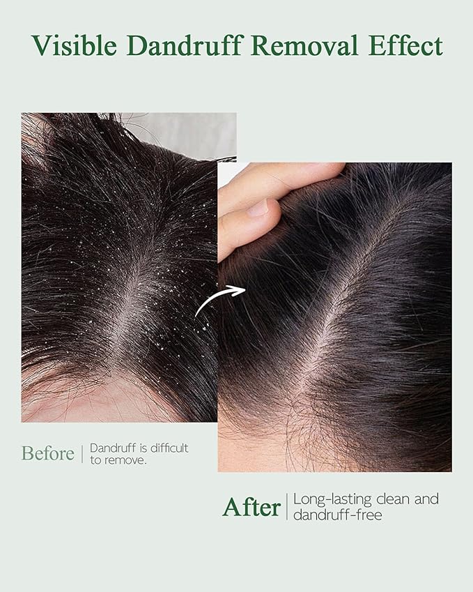Mugwort Scalp Detox Pre-Wash Cleanser – Hydrating & Soothing Scalp Serum with 1% Salicylic Acid, HA & Bifida Ferment, Helps Balance Scalp Barrier & Moisturizing, 2 Pack