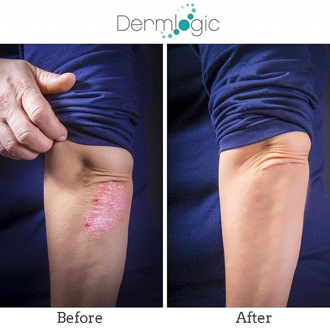 Dermlogic Keratosis Pilaris Treatment- Get Rid of KP, Bumps & Body Acne. 12% Lactic Acid Lotion. Moisturizing Repair Cream Smooths Rough, Dry, Cracked, Bumpy Skin & Redness.