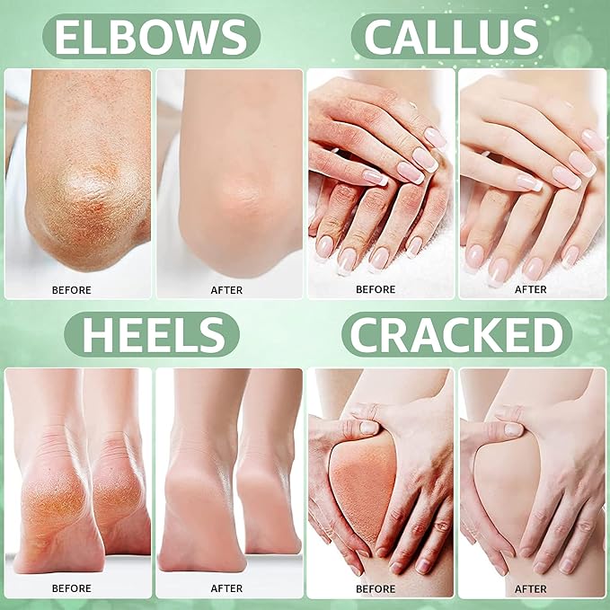 42% Urea Cream MAX with Tea Tree Oil & Aloe Vera - Maximum Strength Formula for Cracked Heels, Thick Calluses & Dry Rough Skin - Fast Absorbing Moisturizer for Feet, Heels, & Dry Cracked Skin - 4oz