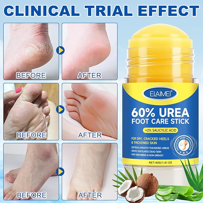 60% Urea Cream Stick with 2% Salicylic Acid, Exfoliating Foot Balm for Dry, Rough Skin on Heels, Knees & Hands, Moisturizing Solid Urea Foot Cream, 1.4 oz