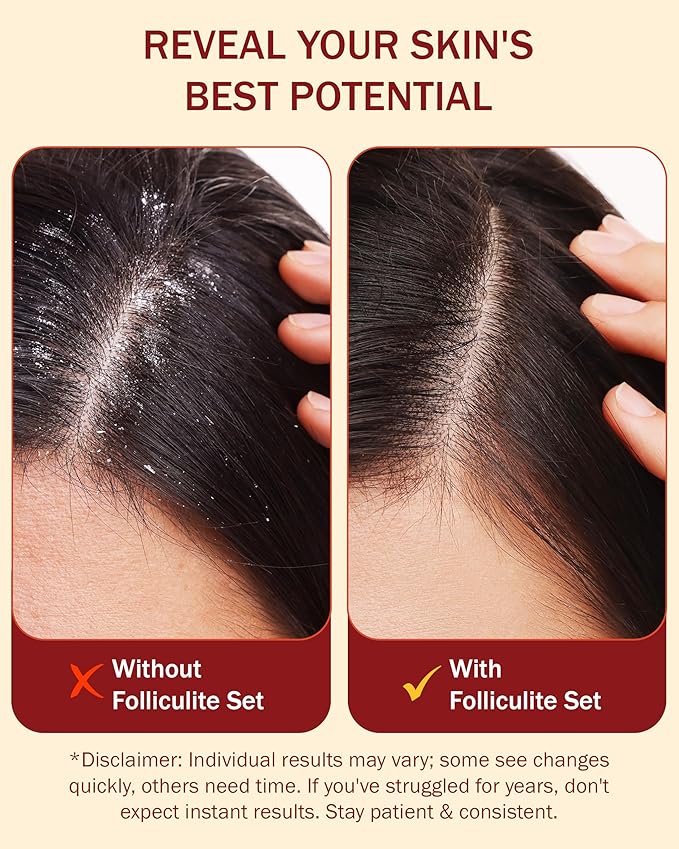 Folliculitis Treatment Leave-On Dry Scalp Serum - 3% BHA, Salicylic Acid, Tea Tree Oil & Peppermint Oil - Non-Greasy Serum for Irritated Flaky Scalp Treatment Acne, Made in USA by e70, 2 fl oz