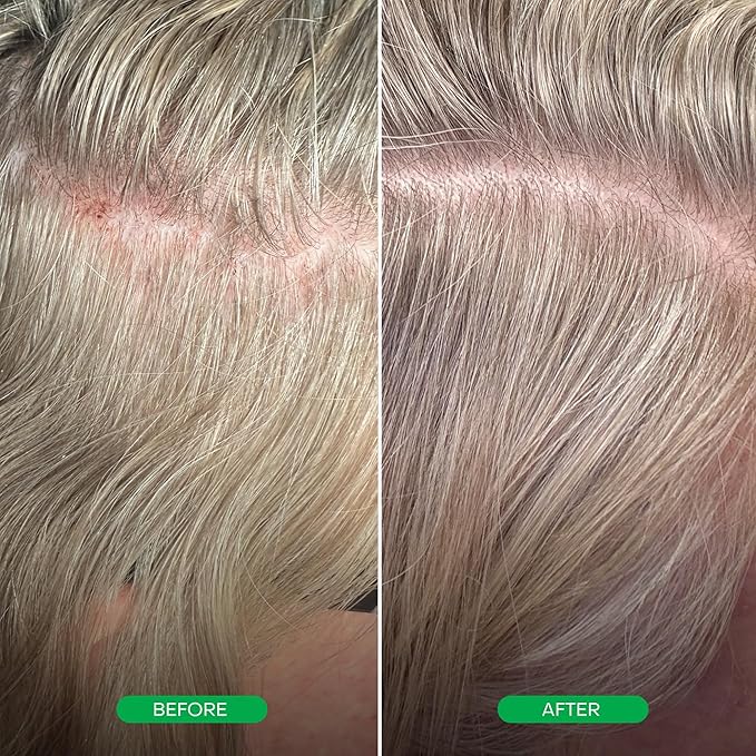 Everist EverBoost Multi-Peptide Scalp Serum | Peptides, Caffeine & Postbiotics | Promotes Visibly Thicker & Fuller-Looking Hair | Brittle, Dry & Thinning Hair | Dermatologist Developed & Tested | 60ml